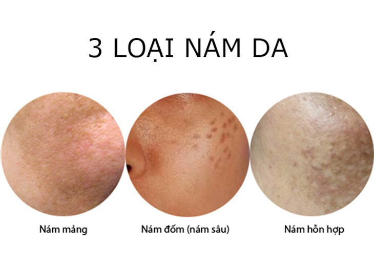 Nám Da Là Gì? Dấu Hiệu Và Giải Pháp Điều Trị Hiệu Quả