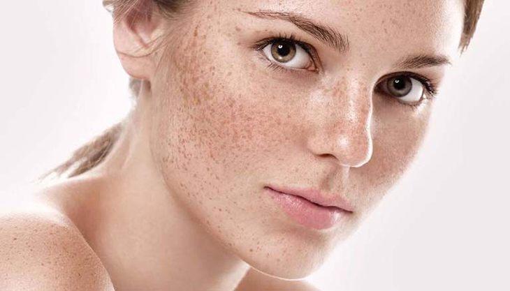 Nám Da Là Gì? Dấu Hiệu Và Giải Pháp Điều Trị Hiệu Quả