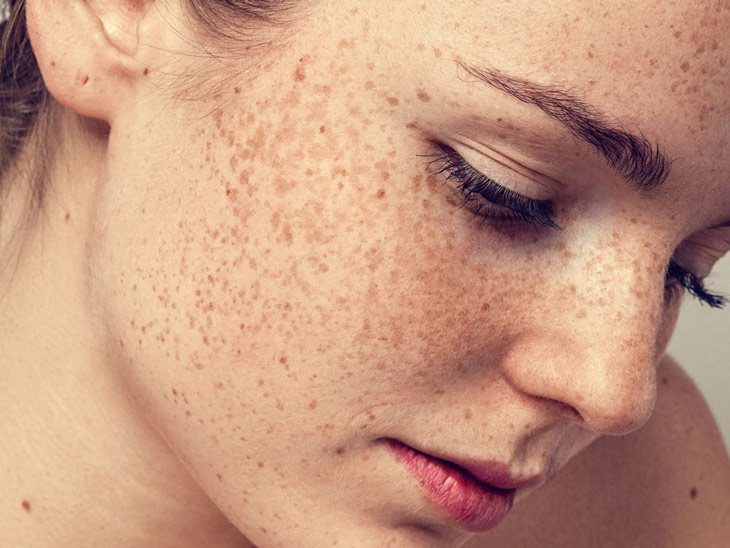 Nám Da Là Gì? Dấu Hiệu Và Giải Pháp Điều Trị Hiệu Quả