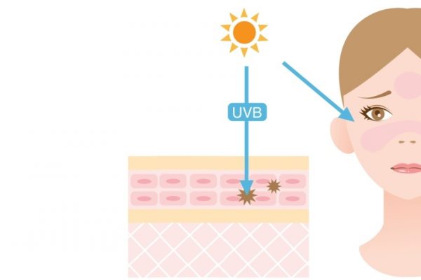 UVB làm gia tăng mạnh mẽ nguy cơ ung thư da
